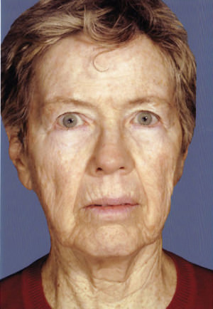 Facelift before photo