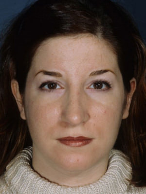 Rhinoplasty result at New York Plastic Surgery