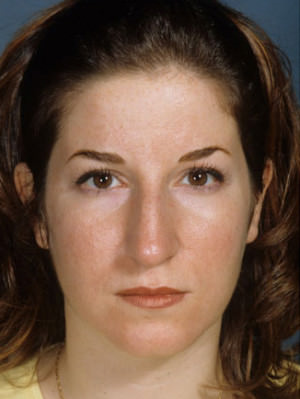 Rhinoplasty before photo