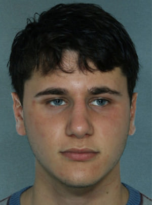 Rhinoplasty result at New York Plastic Surgery