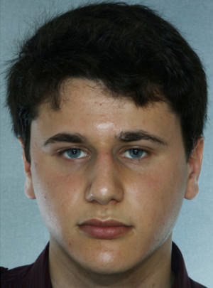 Rhinoplasty before photo