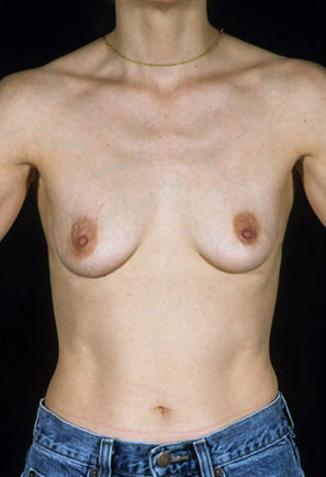 Breast Augmentation before photo