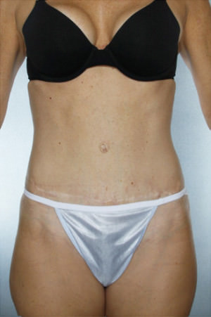 Tummy Tuck result at New York Plastic Surgery