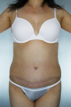 Tummy Tuck result at New York Plastic Surgery