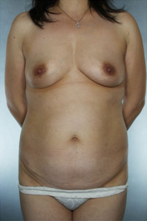 Tummy Tuck before photo