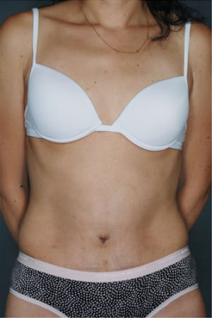 Tummy Tuck result at New York Plastic Surgery