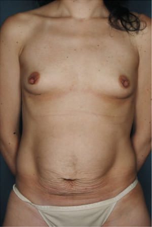 Tummy Tuck before photo