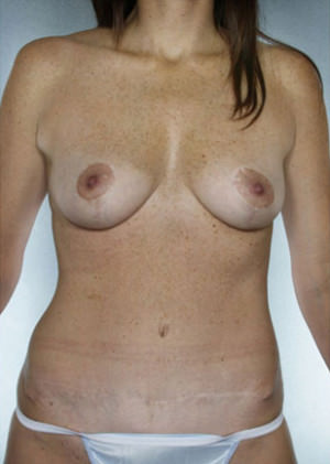 Breast Lift result at New York Plastic Surgery