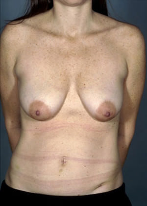 Breast Lift before photo