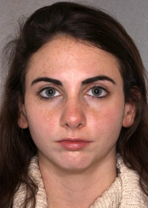 Rhinoplasty result at New York Plastic Surgery