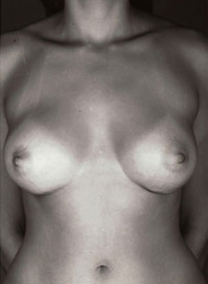 Breast Augmentation result at New York Plastic Surgery