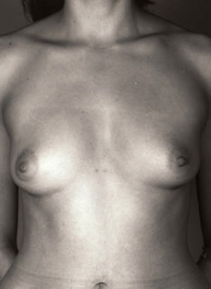 Breast Augmentation before photo