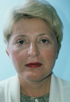 Facelift result at New York Plastic Surgery