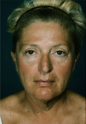 Facelift before photo