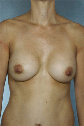 Breast Augmentation result at New York Plastic Surgery