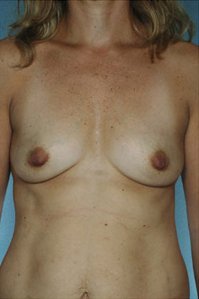 Breast Augmentation before photo