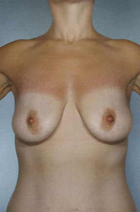 Breast Lift before photo
