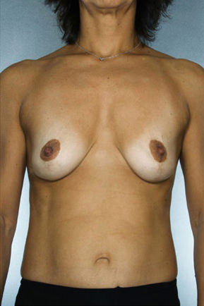 Breast Lift result at New York Plastic Surgery