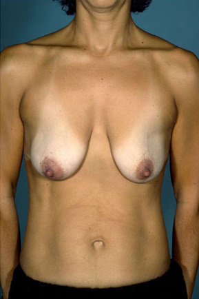 Breast Lift before photo
