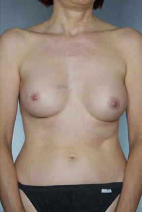 Breast Augmentation result at New York Plastic Surgery