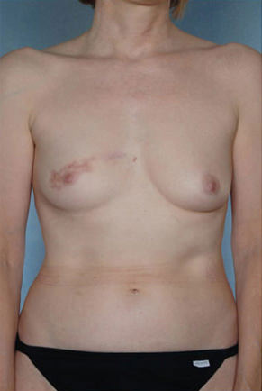 Breast Augmentation before photo