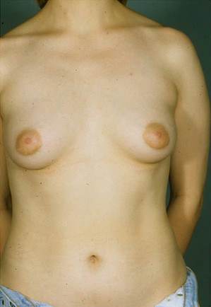 Breast Augmentation result at New York Plastic Surgery