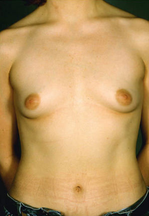 Breast Augmentation before photo