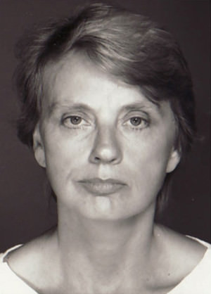 Facelift result at New York Plastic Surgery