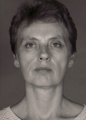 Facelift before photo