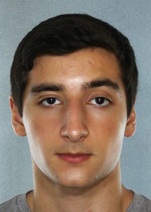Rhinoplasty before photo