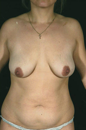 Breast Lift before photo