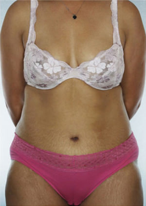 Tummy Tuck result at New York Plastic Surgery