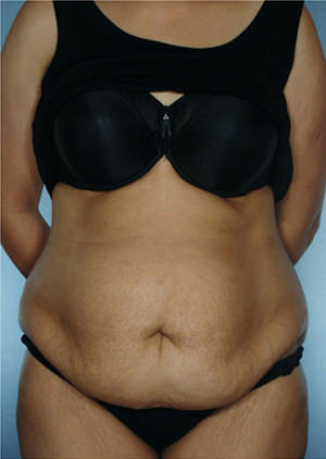 Tummy Tuck before photo