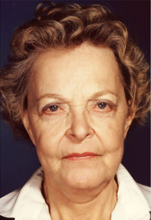 Facelift result at New York Plastic Surgery