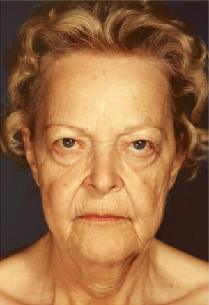 Facelift before photo