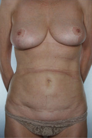 Tummy Tuck result at New York Plastic Surgery