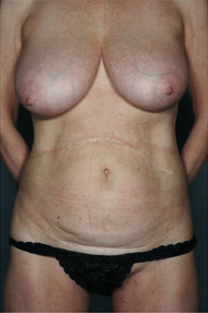 Tummy Tuck before photo