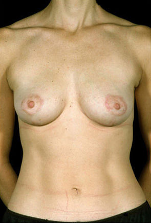 Breast Lift result at New York Plastic Surgery