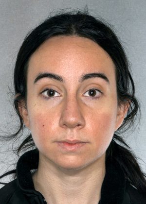 Rhinoplasty result at New York Plastic Surgery