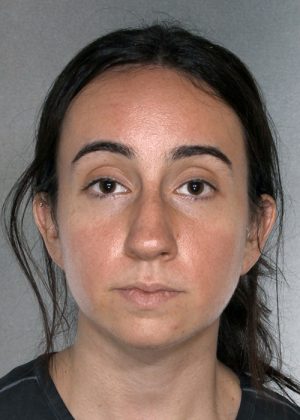Rhinoplasty before photo