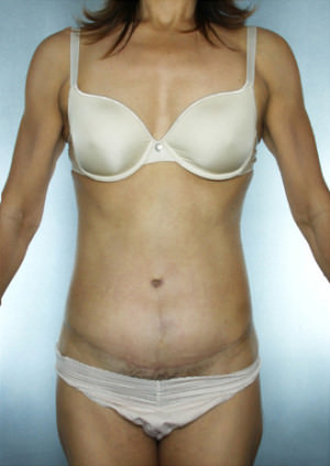 Tummy Tuck result at New York Plastic Surgery