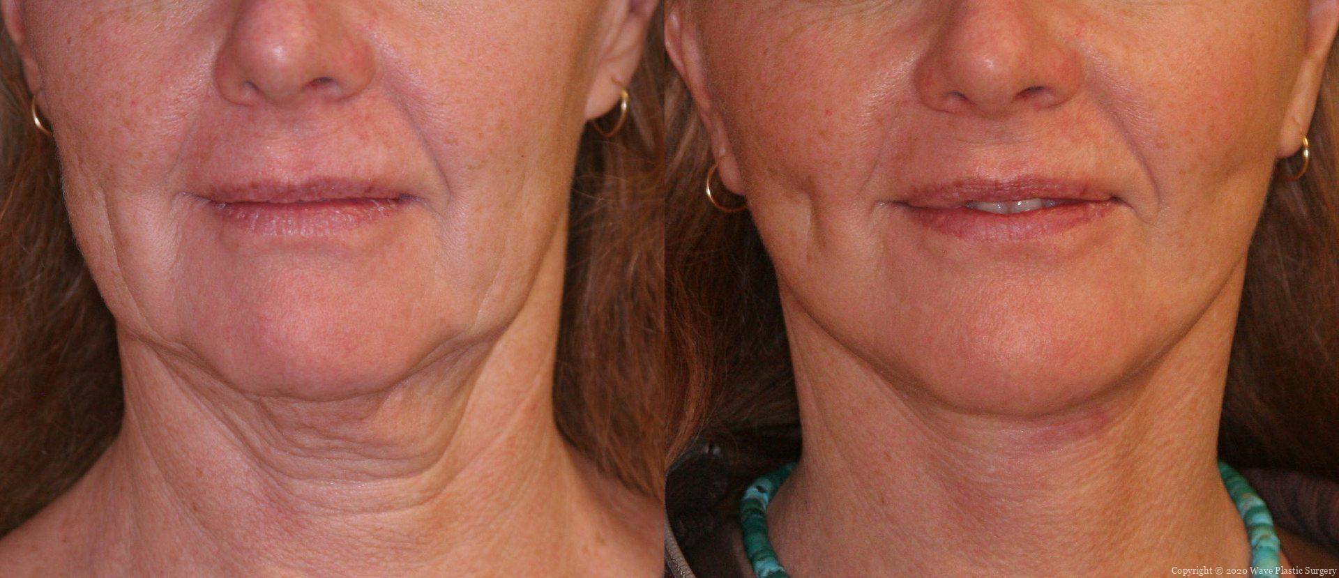 A result from Wave Plastic Surgery & Aesthetic Laser Center Costa Mesa