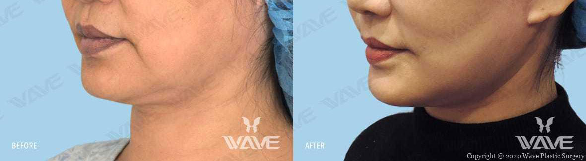 A result from Wave Plastic Surgery & Aesthetic Laser Center Costa Mesa