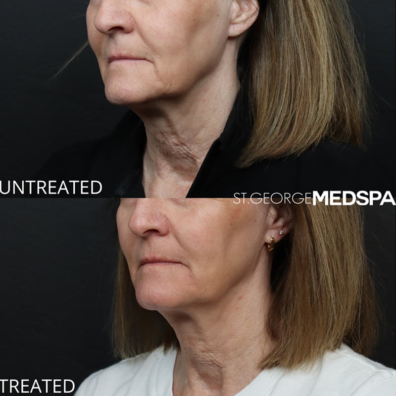 Laser Treatment result at St. George Med Spa