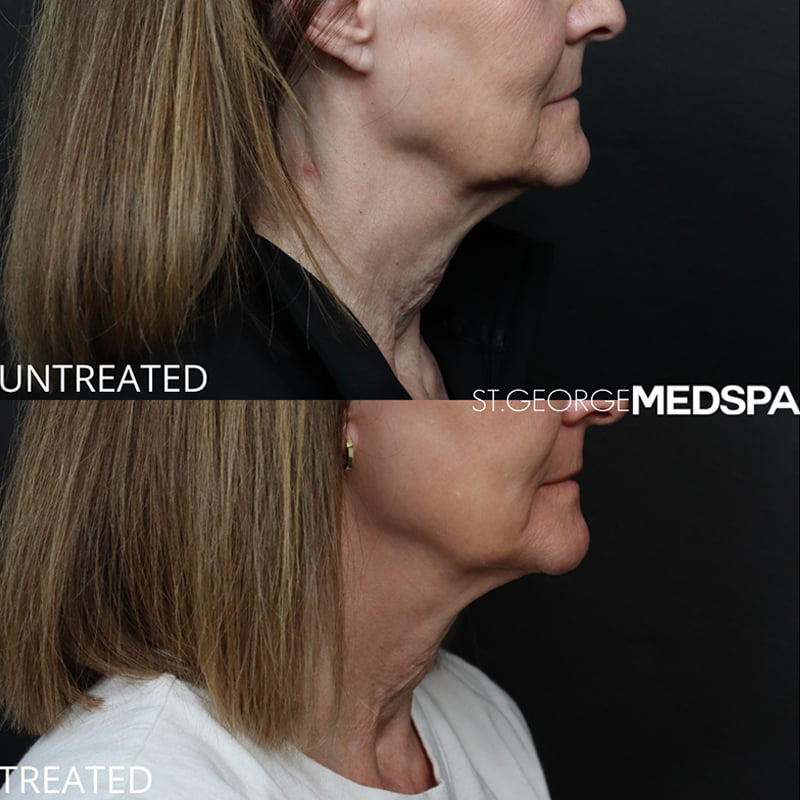 Laser Treatment before photo