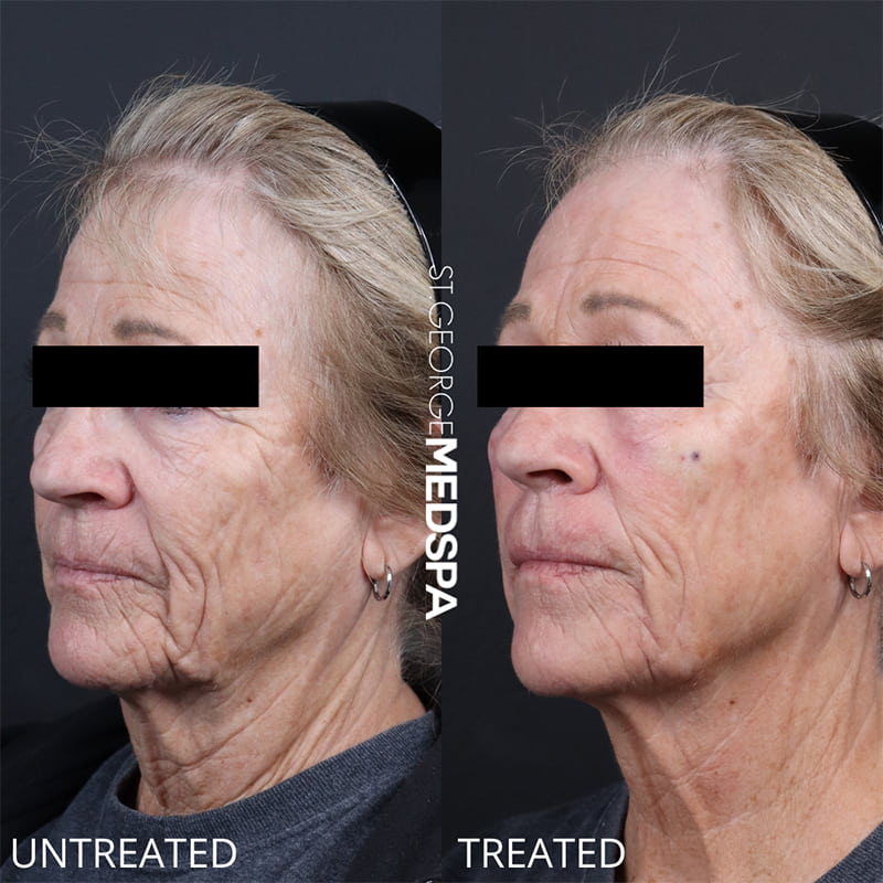 St. George Med Spa cheek filler after — St. George, UT
