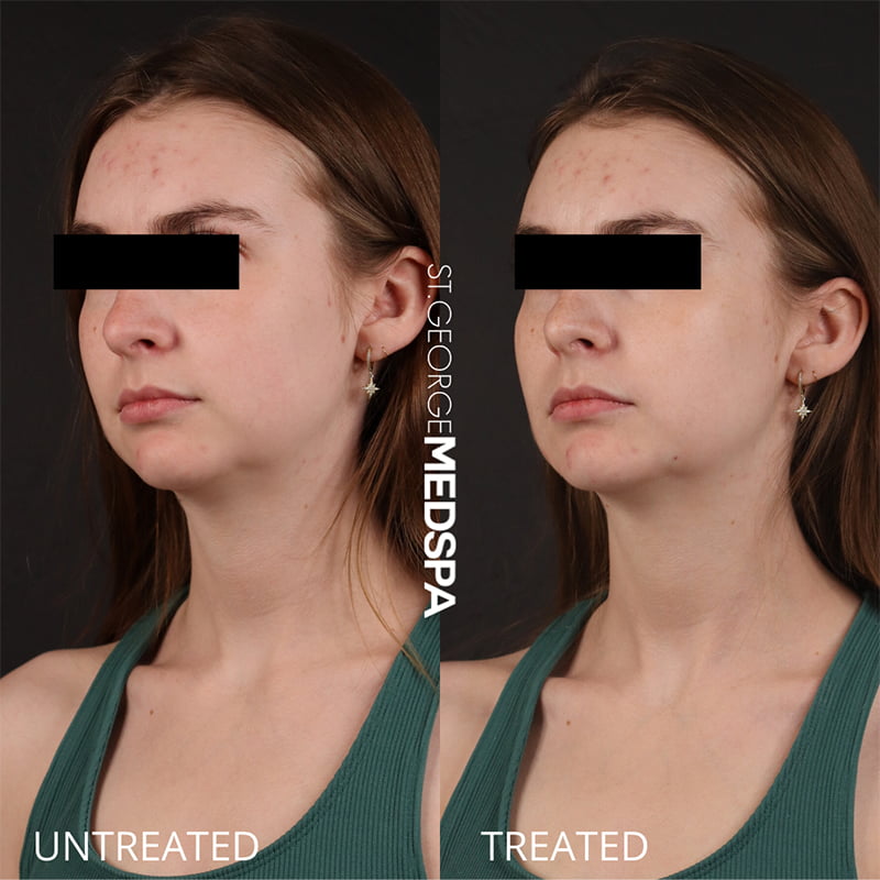 St. George Med Spa cheek filler after — St. George, UT