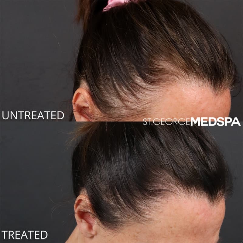 St. George Med Spa cheek filler after — St. George, UT