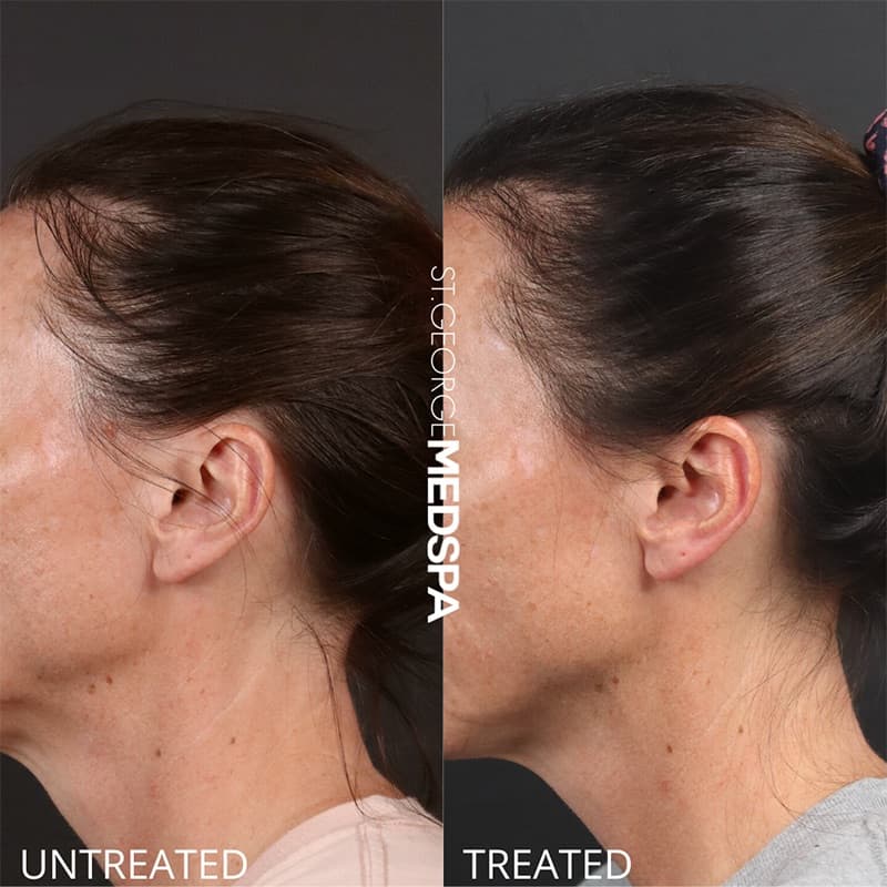 St. George Med Spa cheek filler after — St. George, UT