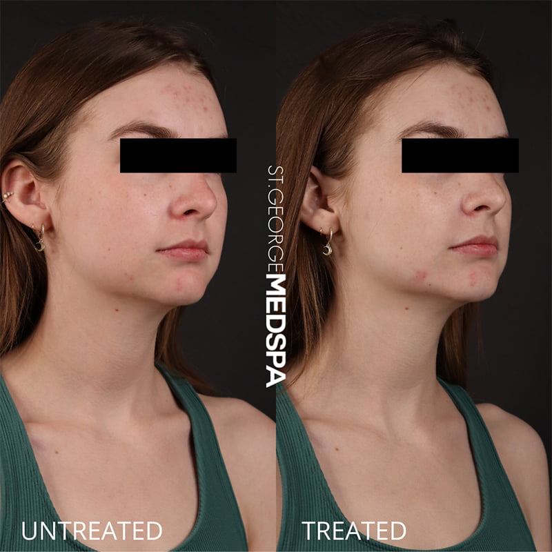 St. George Med Spa cheek filler after — St. George, UT
